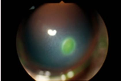 角膜潰瘍（眼の傷）